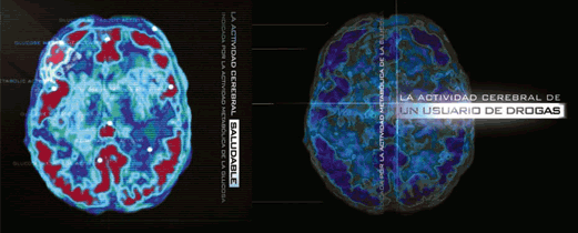 Dos fotos. La primer muestra el cerebro de una personal normal. La segunda muestra el cerebro de alguien que usa drogas. 