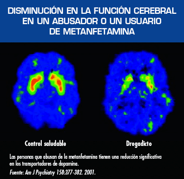 Disminucin de la funcin cerebral en un abusador o usuario de la metanfetamina. Esta imagen muestra dos cerebros. El cerebro vista a la izquierda es saludable. El cerebro a la derecha se ve afectado por la metanfetamina