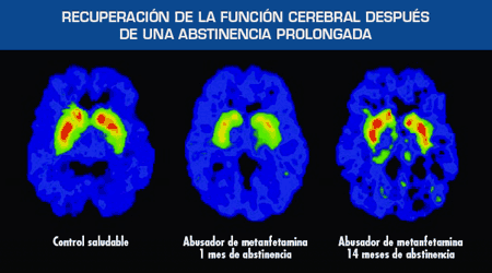 Imagen que muestra la recuperacin de la funcin cerebral despus de la abstinencia prolongada